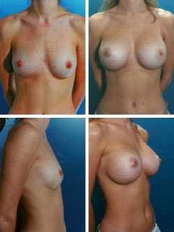 Zephryrhill, FL. Breast Augmentation