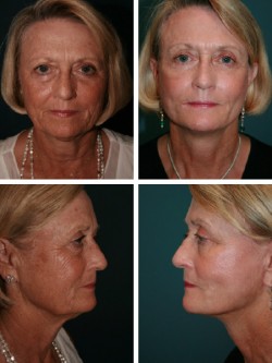 65 year old Mulberry Barton, FL. Facelift with cheek augmentation by SMAS folding placation, neck imbrication and facial skin rejuvenation.