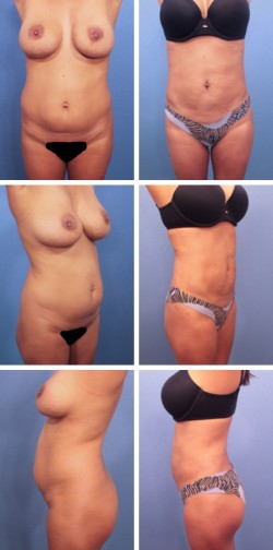 30 year old - Plant City, Mulberry, FL. Liposuction Body contouring with enhanced muscle definition.
