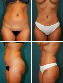 28 year old- Lakeland Plant City, Florida. High definition Vaser liposuction of abdominal musculature & Breast Implants.