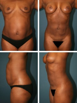 25 year old- Lakeland Bartow, Florida . Vaser Liposuction & Breast augmentation with Vaser ultrasonic contouring to enhance abdominal musculature and waist contours.