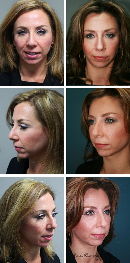 facelift before and after brandon fl