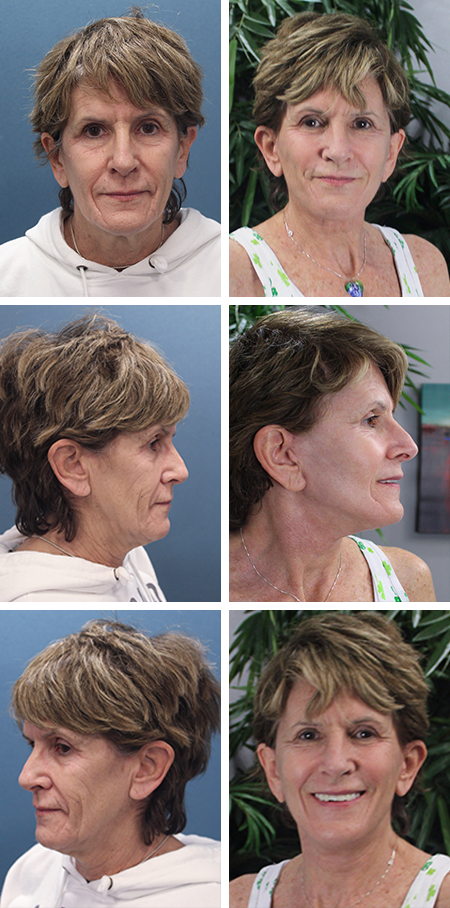 facelift before and after brandon fl