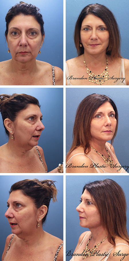 facelift before and after brandon fl