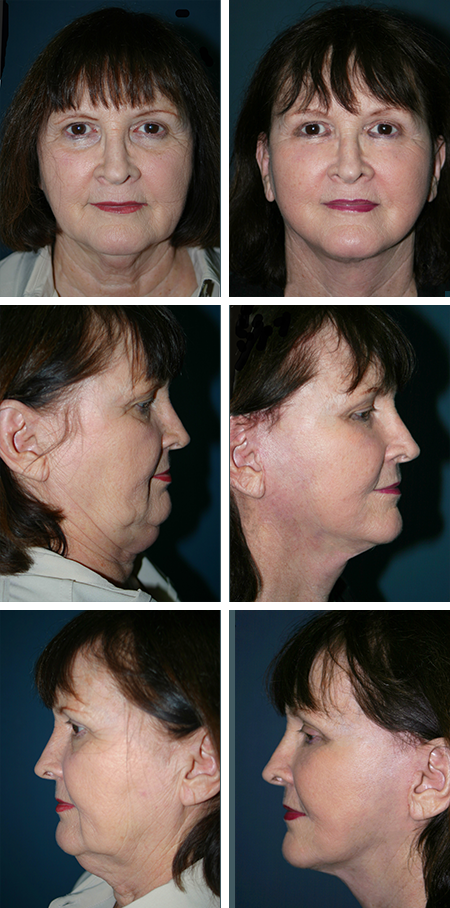 facelift before and after brandon fl