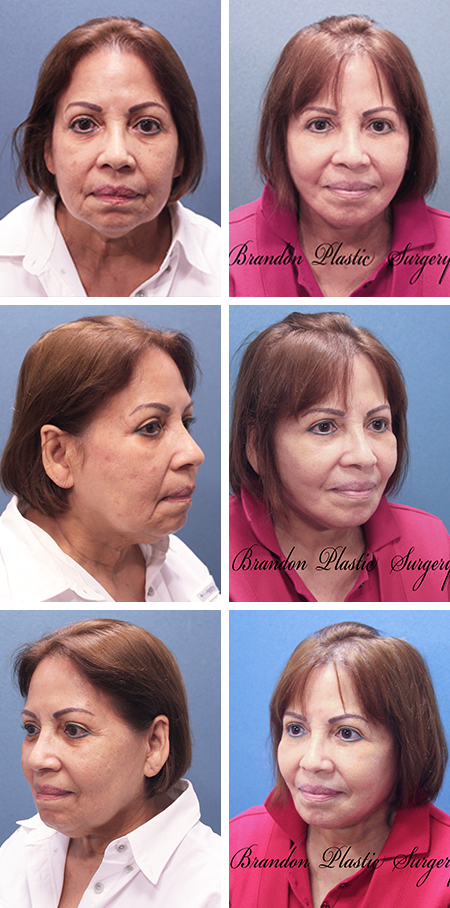 facelift before and after brandon fl