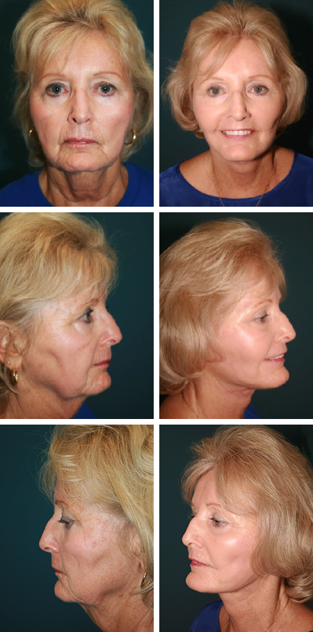 facelift before and after brandon fl