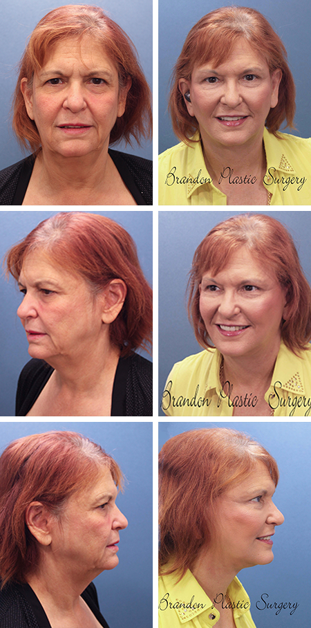 facelift before and after brandon fl