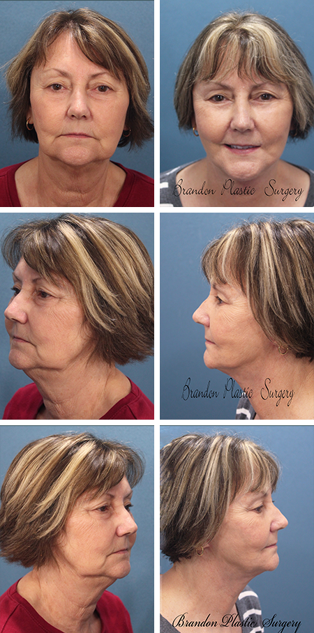 facelift before and after brandon fl