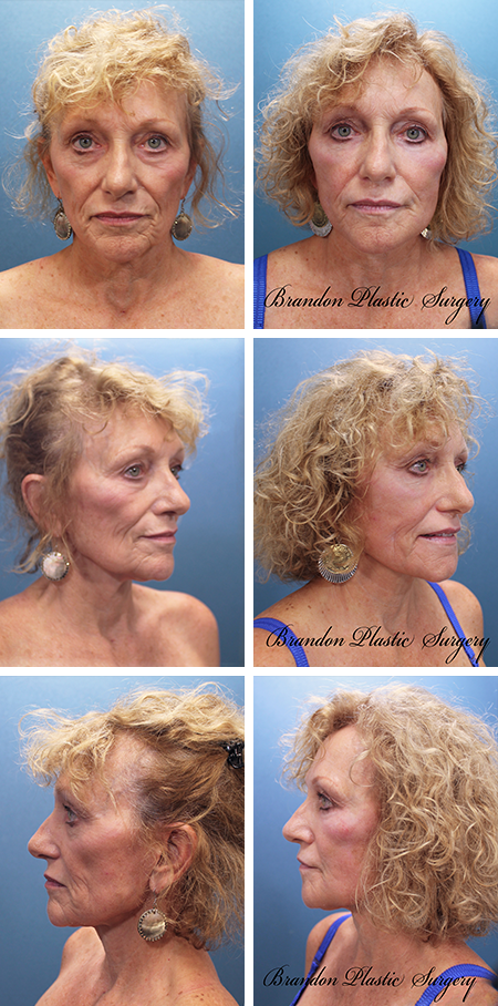 facelift before and after brandon fl