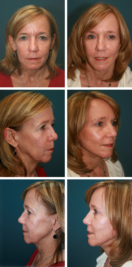 facelift before and after brandon fl