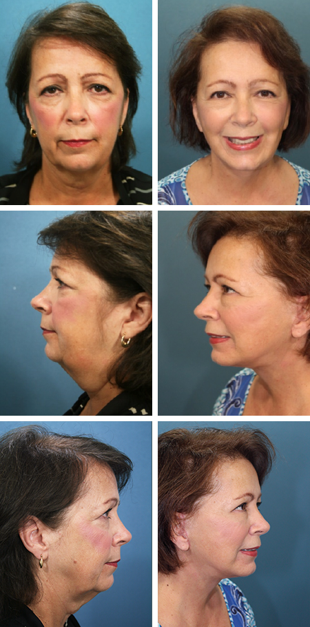 facelift before and after brandon fl