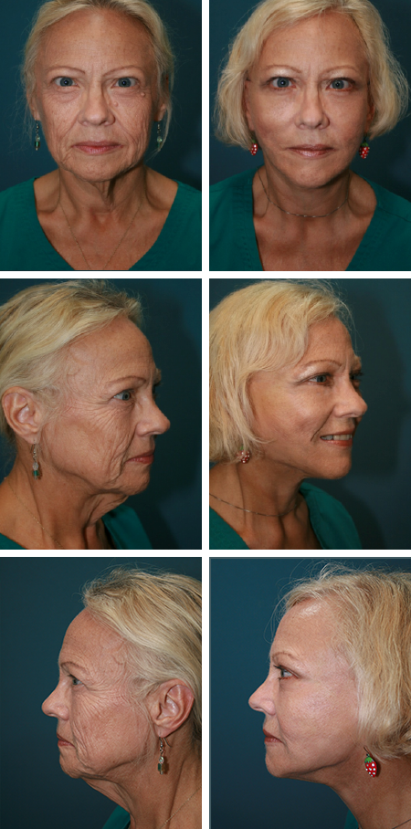 facelift before and after brandon fl