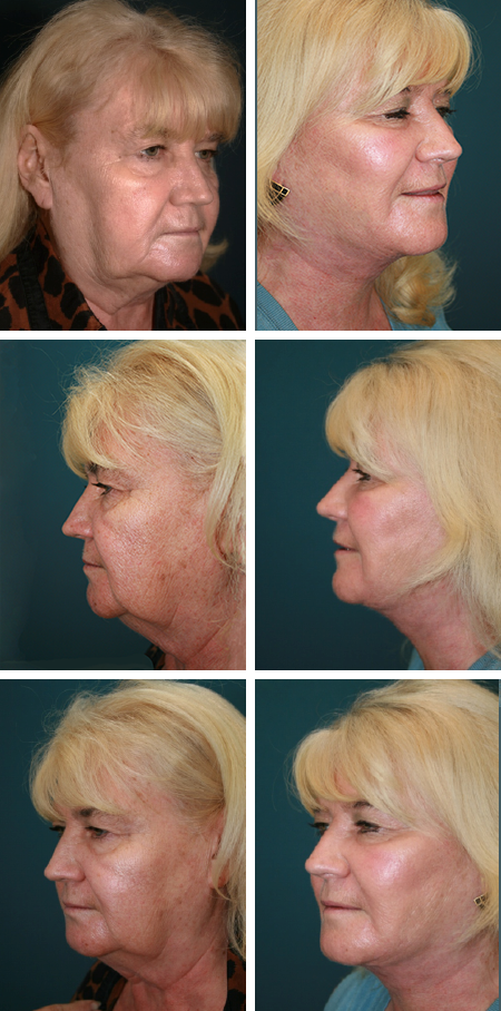 facelift before and after brandon fl