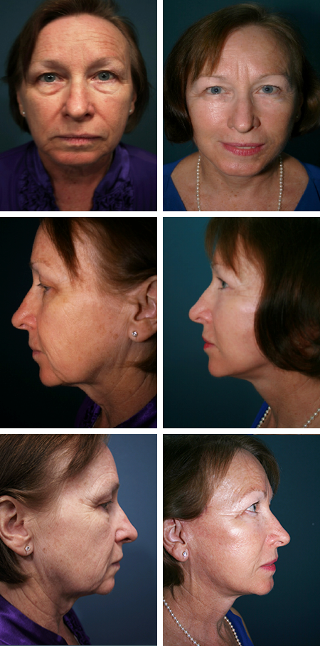 facelift before and after brandon fl