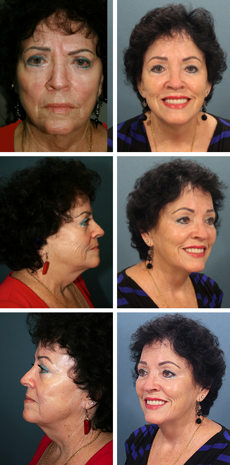 facelift before and after brandon fl