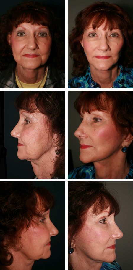 facelift before and after brandon fl