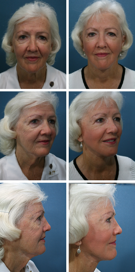 facelift before and after brandon fl