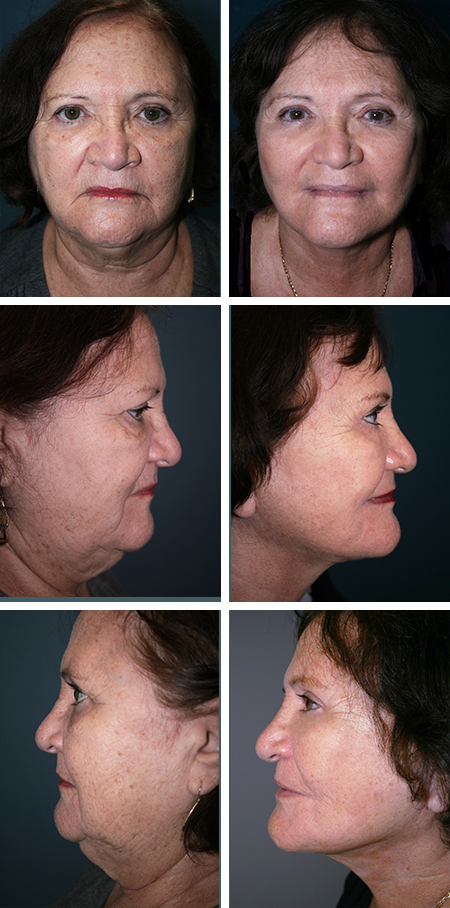 facelift before and after brandon fl