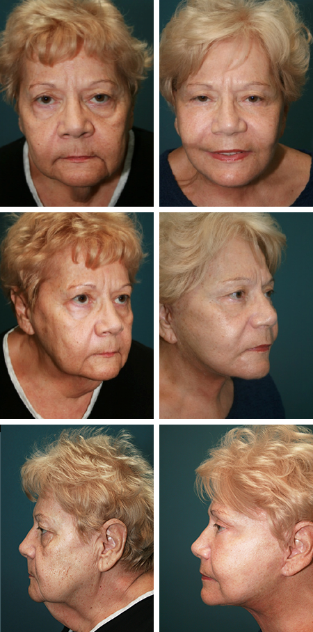 facelift before and after brandon fl