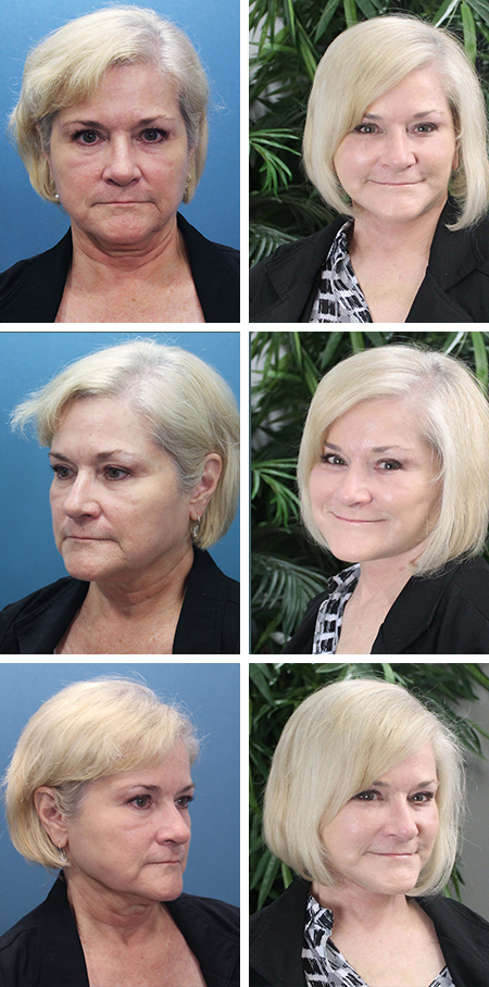 facelift before and after brandon fl