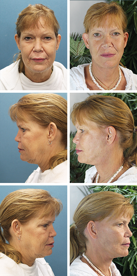 facelift before and after brandon fl