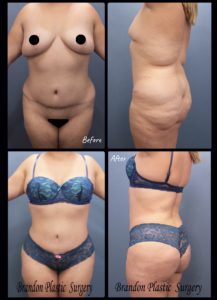 Revision tummy tuck - Hourglass Tummy Tuck