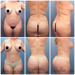 Tummy Tuck (Abdominoplasty) - Restore Plastic Surgery - FL